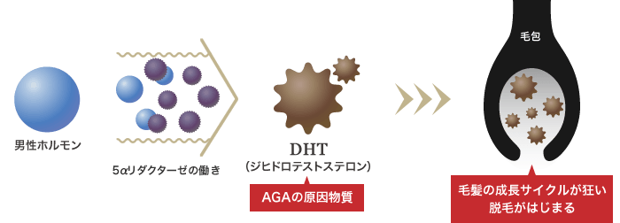 AGAの原因