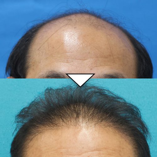 50代 男性 頭頂部 前頭部の自毛植毛の症例 自毛植毛 薄毛対策の植毛専門クリニック アーツ銀座クリニック