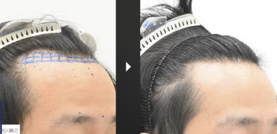 湘南AGAクリニック症例