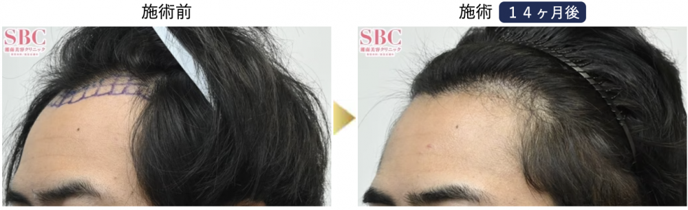 湘南AGAクリニック大阪院症例